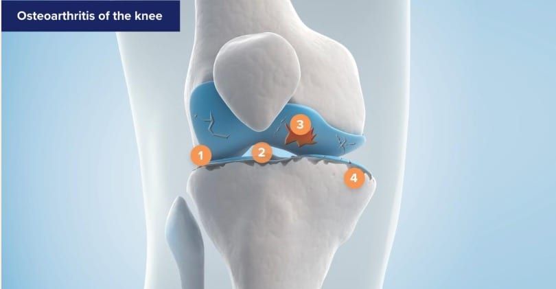 Illustration of the knee joint showing bones and cartilage